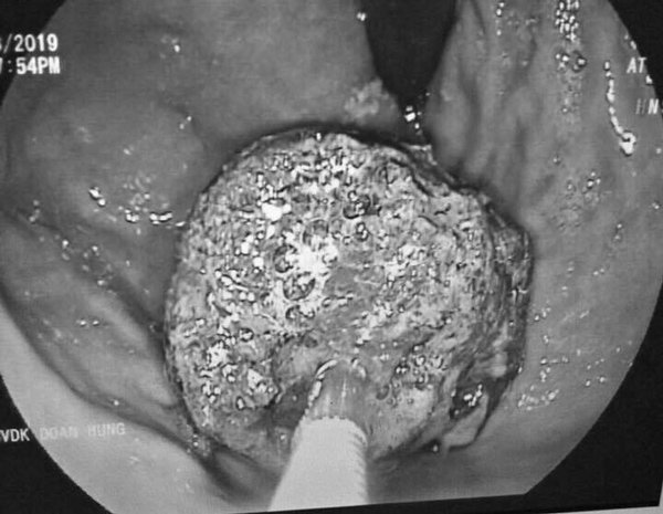 Thường xuyên bỏ cơm, uống trà sữa, chàng trai trẻ bị tắc ruột nhập viện cấp cứu - 1