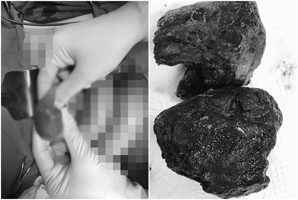 Thường xuyên bỏ cơm, uống trà sữa, chàng trai trẻ bị tắc ruột nhập viện cấp cứu - 2