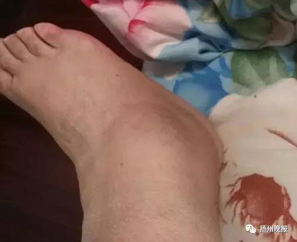 cho nhan vien massage nan bop suot 2 tieng, nguoi phu nu dau don phai nhap vien - 1