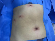 Sức khỏe - Người phụ nữ bị táo bón nhiều ngày, bác sĩ choáng khi lấy cả nghìn viên sỏi mật trong bụng