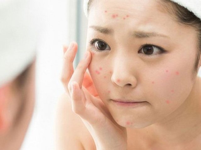 Bỏ ngay những thói quen này nếu không muốn khổ sở vì gương mặt chi chít mụn