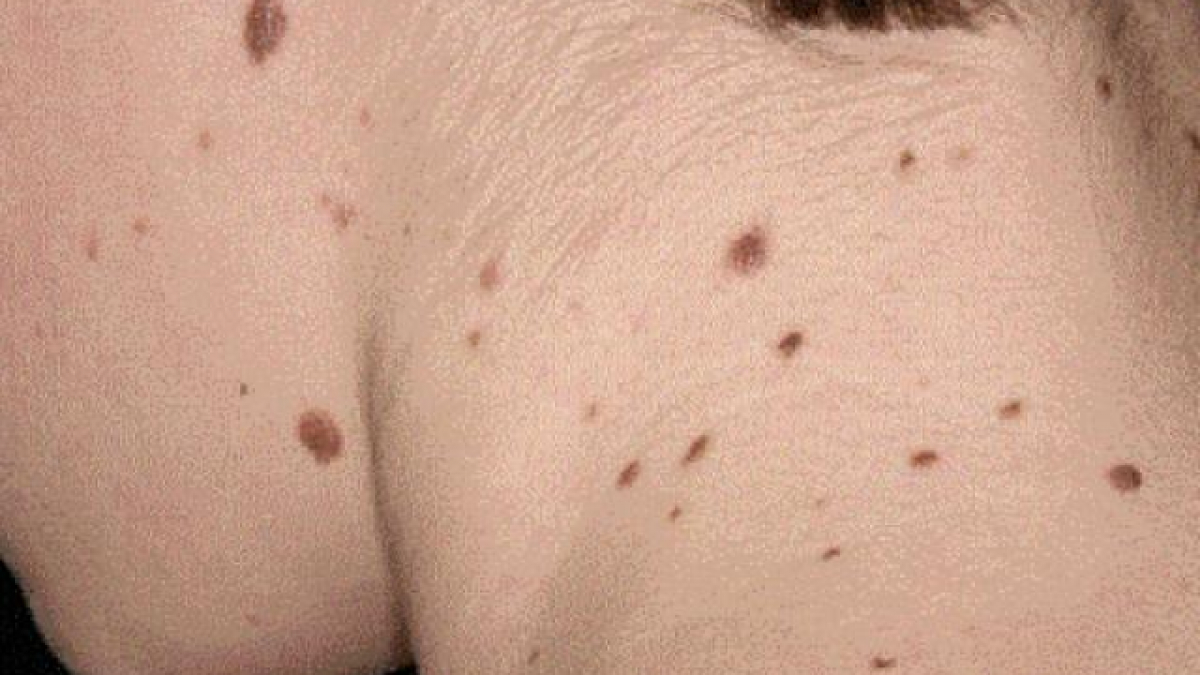 Xuất hiện đốm đen tr&ecirc;n da, nguy&ecirc;n nh&acirc;n do đ&acirc;u?