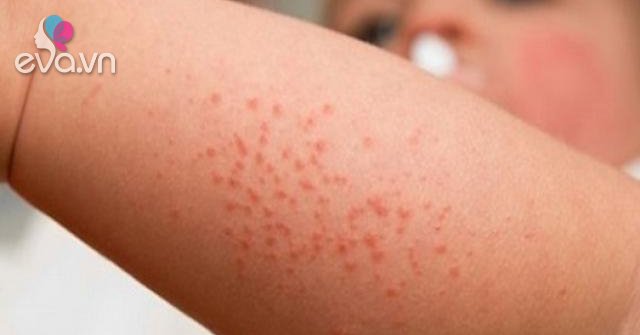 13 nguyên nhân gây nổi mẩn đỏ không ngứa