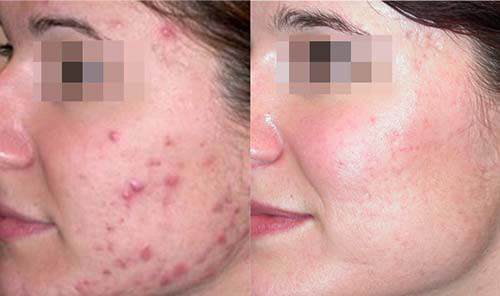 Giã nát rau diếp cá rồi cho thêm thứ này, mụn cứng đầu đến đâu cũng hết sạch đến đó - 4