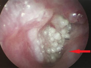 Sức khỏe - Người đàn ông mắc sùi mào gà vì lấy ráy tai ngoài tiệm: cảnh báo những thói quen rước bệnh