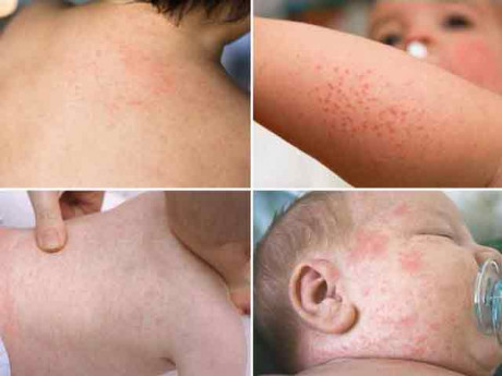 Sốt phát ban ở trẻ cần kiêng gì và cách chăm sóc ra sao?