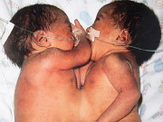 Tin tức - Hình ảnh mới của hai bé gái sinh đôi dính liền từ ngực đến bụng cách đây 16 năm