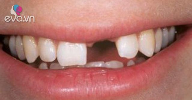 Cô gái 28 tuổi mất hoàn toàn hàm răng trên, thủ phạm là căn bệnh nhiều người cũng mắc