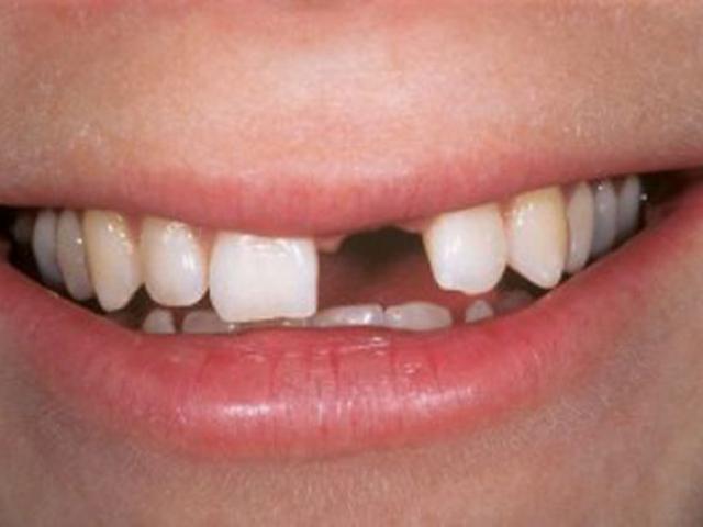 Cô gái 28 tuổi mất hoàn toàn hàm răng trên, thủ phạm là căn bệnh nhiều người cũng mắc