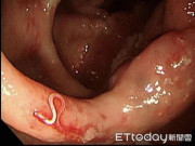 Sức khỏe - Bác sĩ lôi 12 con ký sinh trùng trong ruột người đàn ông, bệnh do ăn sashimi, hải sản sống