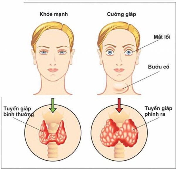 11 biến chứng suy tuyến giáp nguy hiểm khôn lường cần biết - 1