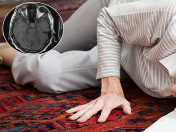Người đàn ông bị "chết" não, không thể nói hay đi lại bình thường vì mắc bệnh giang mai