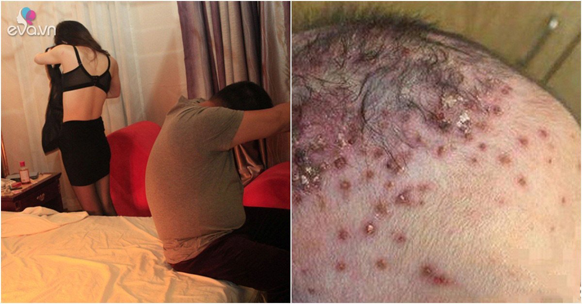 "Tranh thủ" với gái lạ, người cha mắc 4 bệnh tình dục khiến con nhỏ cũng phải chịu hậu quả