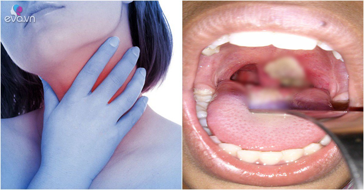 Căn bệnh khiến bé gái tử vong, 31 người phải cách ly nguy hiểm thế nào, phòng tránh ra sao?