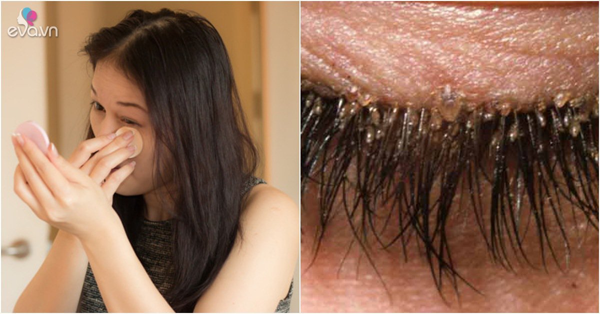 Lười tẩy trang, người phụ nữ "nuôi" hàng trăm con ve trên lông mi khiến bác sĩ hãi hùng