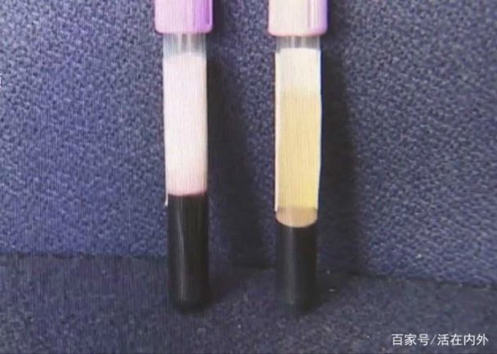 Ăn bánh trung thu suốt 4 tháng, máu của người đàn ông đột nhiên chuyển màu trắng - 2