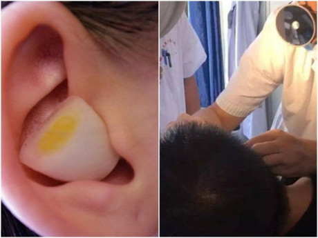 Nhét tỏi vào lỗ tai để trị đau tai gây mất ngủ, người đàn ông phải nhận kết đắng