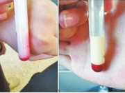 Bà bầu - Mẹ bầu lấy máu khám thai ra toàn màu trắng đục, bác sĩ tái mặt, chồng không thể bình tĩnh