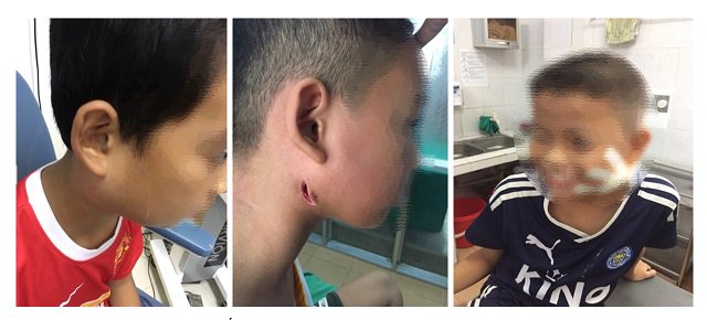 phat hien 3 tre o nghe an mac vi khuan an thit nguoi, gia dinh tuong bi quai bi - 1