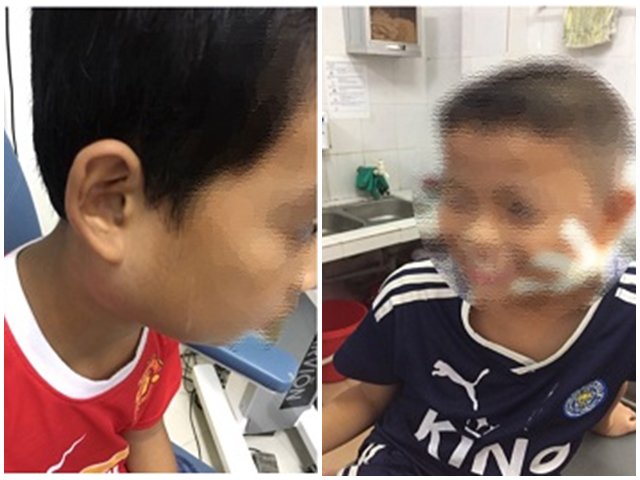 Thông tin mới nhất về sức khỏe 3 trẻ mắc vi khuẩn ăn mòn cơ thể Whitmore tại Nghệ An