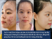 Bí quyết làm đẹp - Một liệu trình trị mụn tại spa giá bao nhiêu? Bao lâu thì hết mụn?