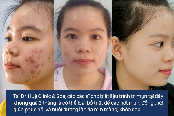 LIỆU TRÌNH TRỊ THÂM MỤN BẰNG CÔNG NGHỆ PEEL DA HOẶC LASER HIỆU QUẢ CAO