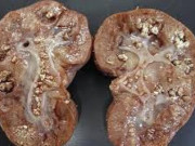 Sức khỏe - Những thói quen cực xấu khiến thận chứa cả "túi" sỏi lổn nhổn