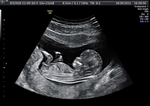 Thai 18 tuần phát triển nhanh, cơ thể mẹ có nhiều thay đổi - 3