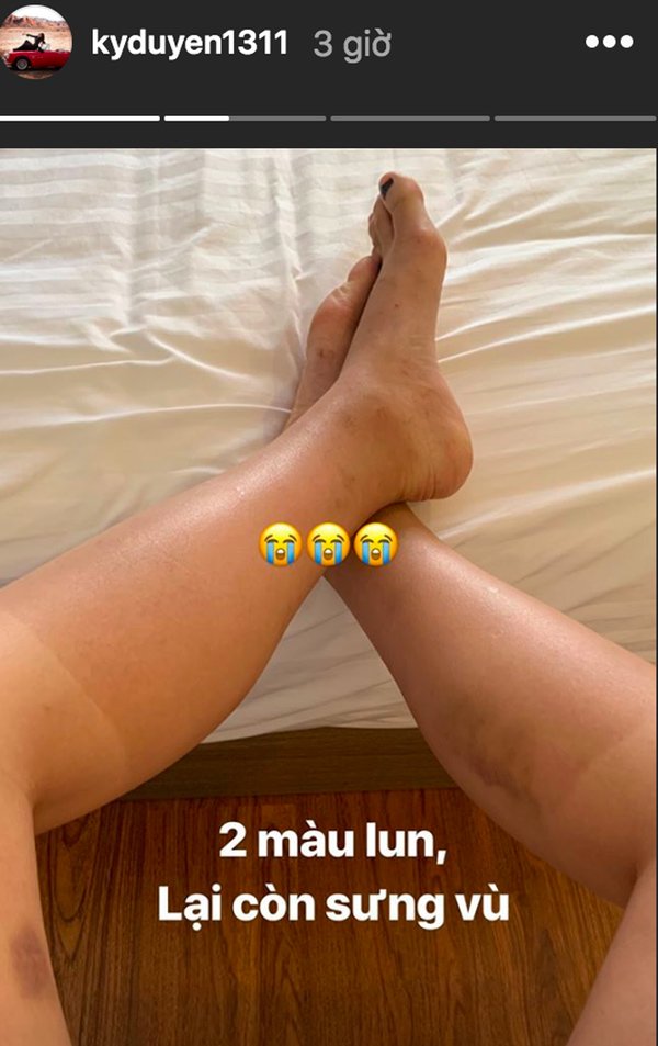 Loang lổ kém thẩm mỹ vì cháy nắng, Kỳ Duyên vẫn thấy tự hào về đôi chân của mình - 2