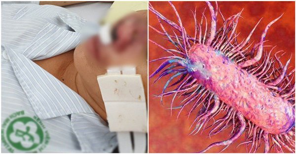 Bệnh Whitmore có thật sự là vi khuẩn amp;#34;ăn thịt ngườiamp;#34;: Chuyên gia lý giải sự thật - 3