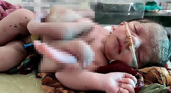 Vợ chồng mù chữ mang bầu không đi siêu âm, đến ngày sinh nhìn con tưởng amp;#34;quái vậtamp;#34; - 2