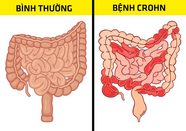 bung day hoi ai cung gap nhung can than no co the canh bao 6 benh nguy hiem chet nguoi - 4