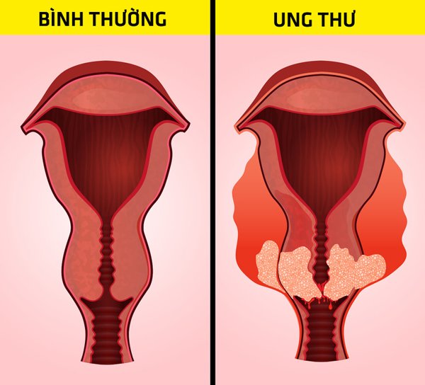 bung day hoi ai cung gap nhung can than no co the canh bao 6 benh nguy hiem chet nguoi - 6