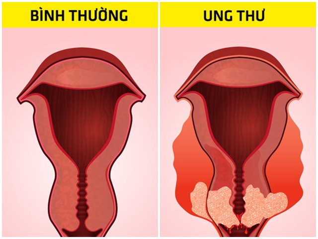 Bụng đầy hơi ai cũng gặp nhưng cẩn thận nó có thể cảnh báo 6 bệnh nguy hiểm chết người