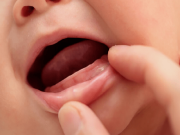 Bé mọc răng chậm cha mẹ nên xử trí thế nào?