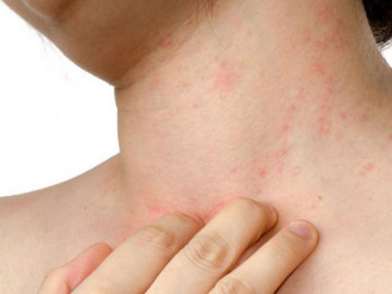 Nguyên nhân gây dị ứng da mẩn đỏ ngứa