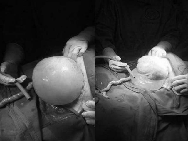 Bác sĩ bất ngờ đón bé gái còn nguyên trong bọc ối khi mổ cho thai phụ mang song thai