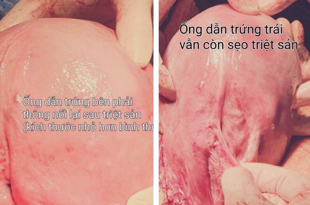 Đã triệt sản thành công, mẹ 3 con ngớ người phát hiện mang thai đứa thứ 4 - 1