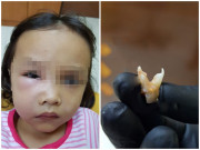 Sức khỏe - Bé gái suýt chết vì sâu răng, nha sĩ trách cha mẹ hại con vì thói quen tai hại
