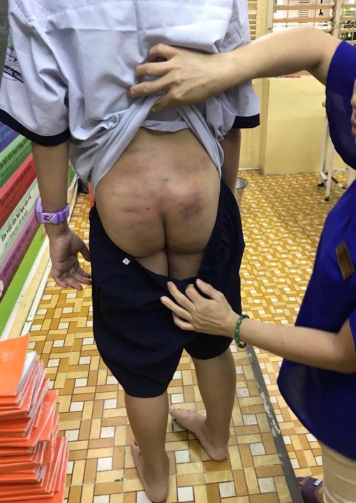 Bố mẹ ly hôn, bé 10 tuổi đầy vết bầm tím, mẹ ruột khóc: amp;#34;Chẳng mẹ nào muốn bỏ conamp;#34; - 1