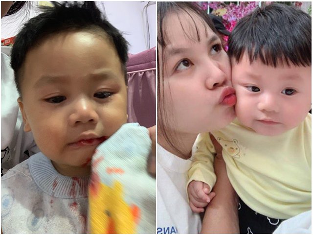 Con nhiễm bệnh từ nụ hôn của người thân, mẹ Việt hoảng loạn khi miệng bé chảy máu không ngừng
