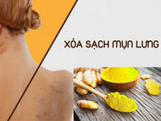 Làm đẹp - 10 cách trị mụn lưng tại nhà cho nữ từ nguyên liệu tự nhiên hiệu quả