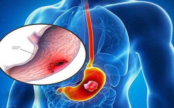 Bé 10 tuổi mắc ung thư dạ dày, chuyên gia chỉ rõ điều cần biết để tránh lây cho con - 2