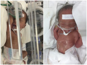 Bà bầu - Rỉ ối 28 tuần bác sĩ lắc đầu, mẹ Bắc Giang sinh xong chẳng kịp nhìn mặt con