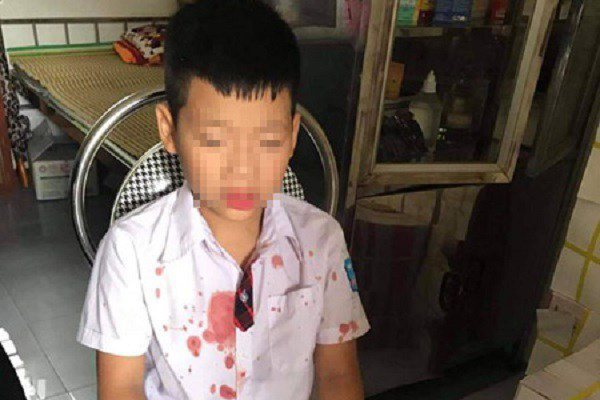 Vụ bé trai lớp 1 bị bố của bạn đánh tóe máu: “Con liên tục kêu mẹ ơi, cứu con” - 1
