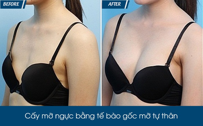 Những bộ phận an toàn cho kiểu làm đẹp hút mỡ chỗ thừa, amp;#34;đắp đầyamp;#34; chỗ thiếu nàng cần biết - 4