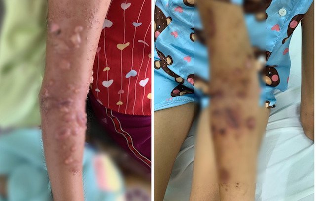 Bé 8 tuổi bị bỏng da nặng vì sứa: Cách sơ cứu nhiều người không biết