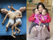 Tin tức - Hình ảnh mới nhất của cặp song sinh dính liền ngực, tách ra sẽ có nguy cơ mất một người