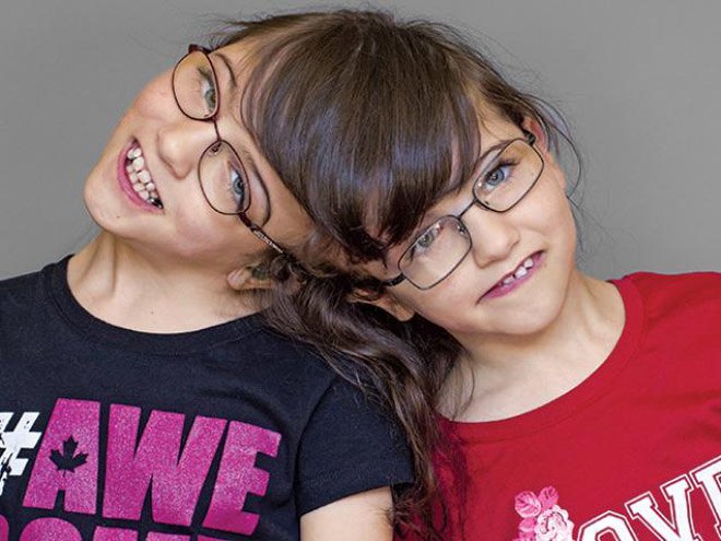 Những cặp song sinh dính liền không tách nhau vẫn sống sót, có trường hợp  còn sinh 21 người con