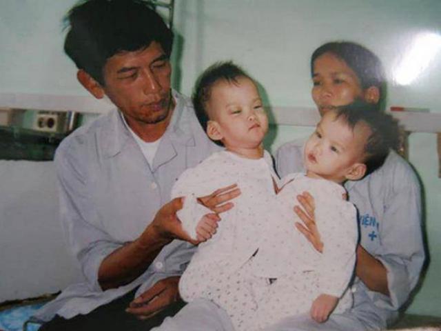 Cặp song sinh dính liền nổi tiếng Cúc-An thay đổi sau 17 năm phẫu thuật tách rời